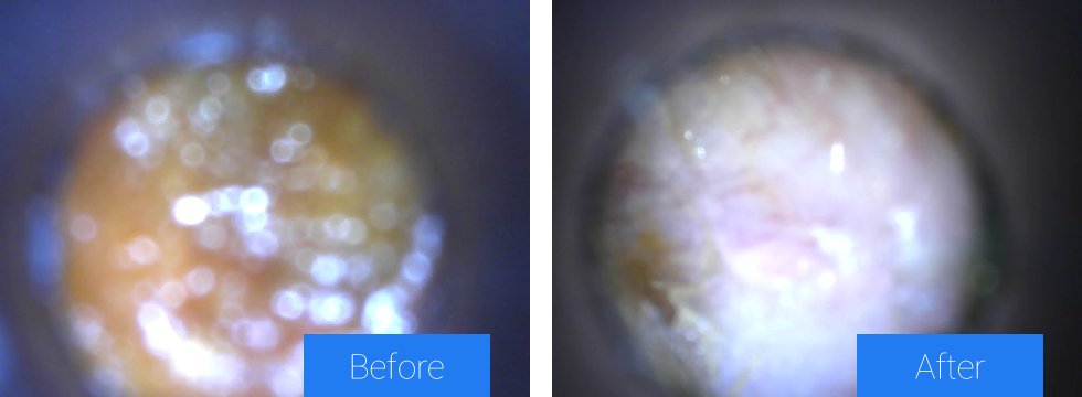 Earwax Removal Before and After